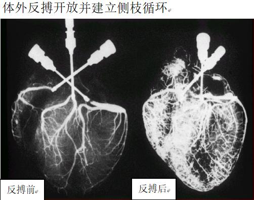 【健康科普】心脏康复的“心”武器-体外反搏