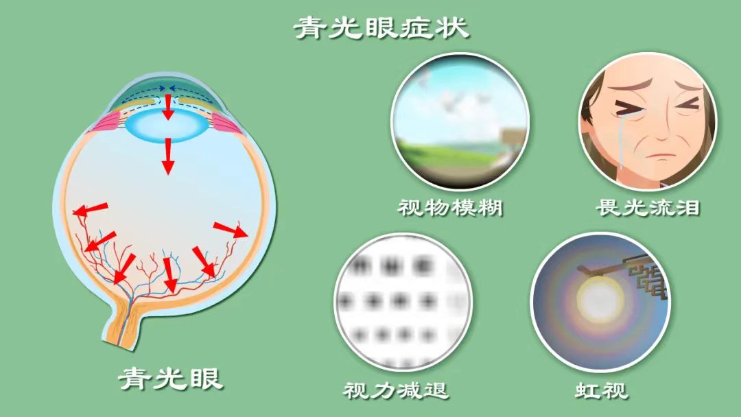 【健康科普】“世界青光眼日”——共管慢病青光眼，留得光明恒久远